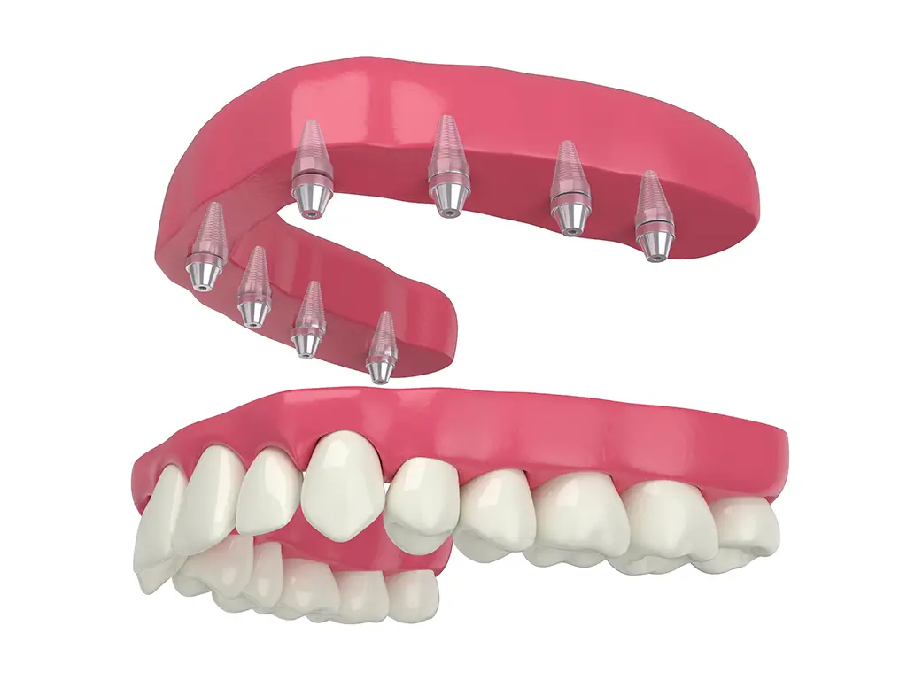 Een klikgebit met implantaten in de kaak bij Praktijk Molenweg