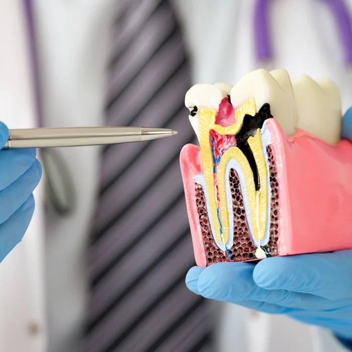 Tandvleesontsteking – parodontologie Tandvleesontsteking - parodontologie